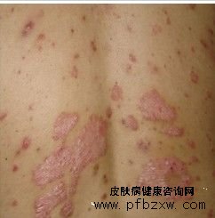 芦荟对牛皮癣患者皮损的恢复有作用吗