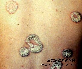 为什么牛皮癣疾病的治疗需要这么长时间