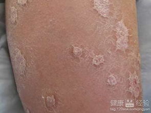 牛皮癣治疗,牛皮癣疾病的治疗有特效药物吗